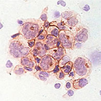 NK細胞ががん細胞を攻撃している顕微鏡写真